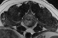 脊髄のMRI２枚目