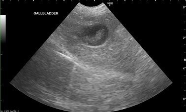 胆嚢粘液嚢腫の超音波画像
