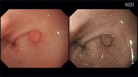 胃の過形成性ポリープの内視鏡画像