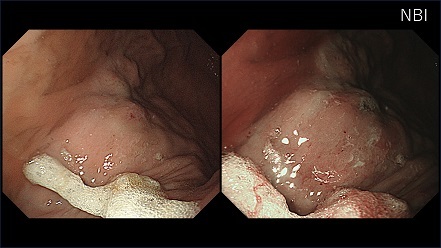 リンパ球形質細胞性胃炎の内視鏡画像