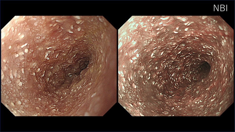 リンパ球形質細胞性十二指腸炎およびリンパ管拡張症の内視鏡画像